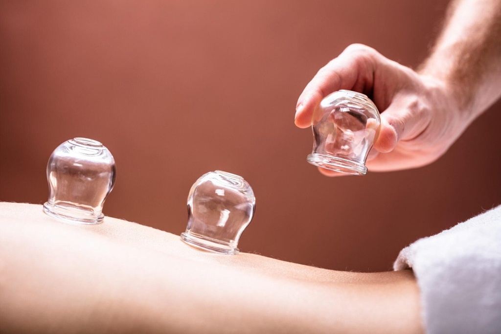 Hijama Cupping