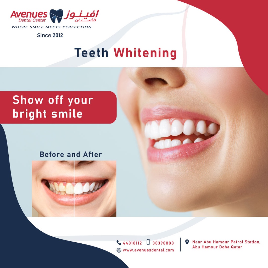 Tooth Whitening