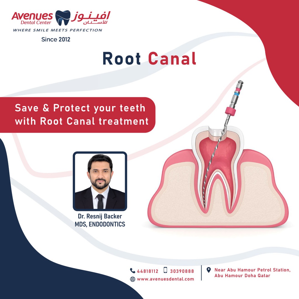 Root Canal